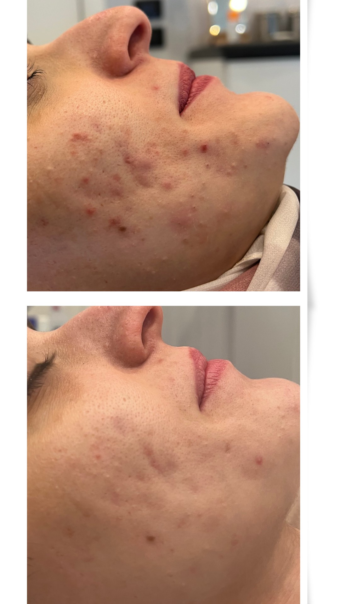 Before and after acne treatment result 1 — The Acne Glow