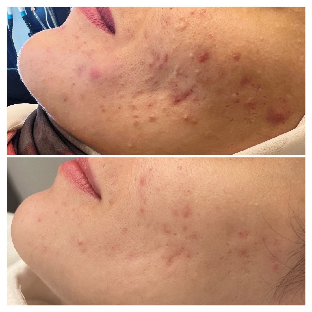 Before and after acne treatment result 2 — The Acne Glow